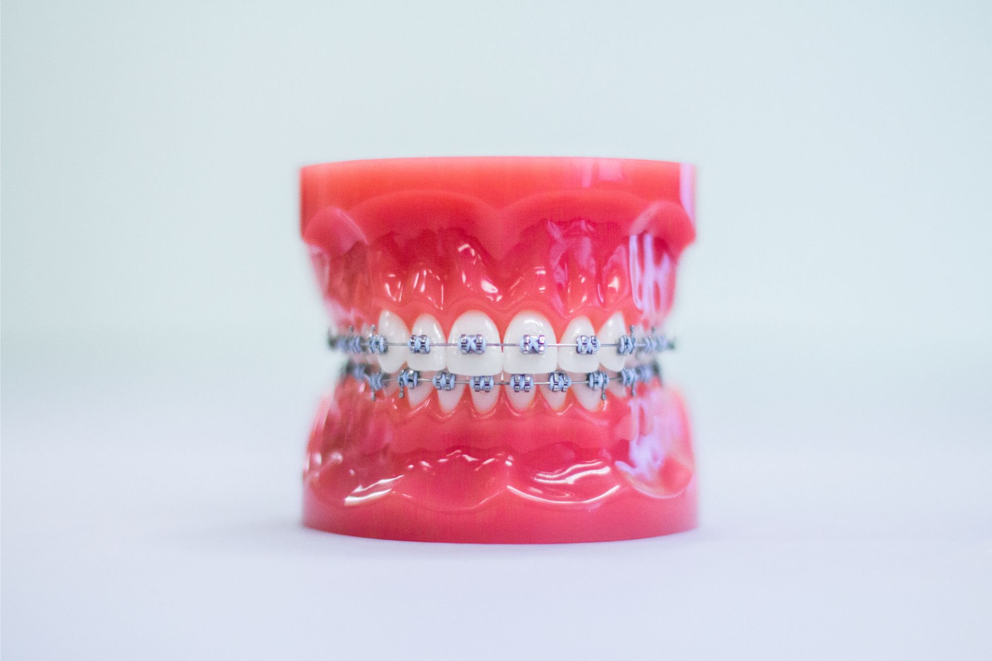 Importance of Elastics With Orthodontic Treatment - Maddux Orthodontics