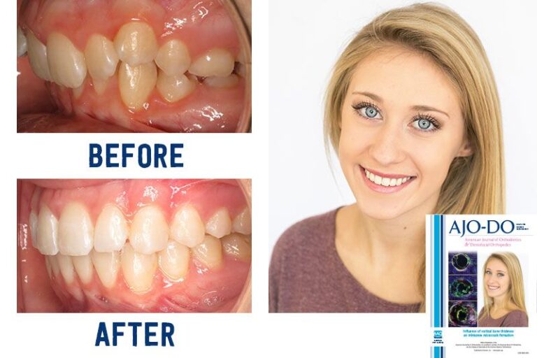 Before & Afters Ryan Cox Orthodontics Orthodontist Rome