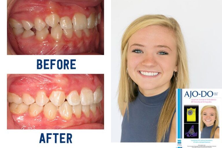 Before & Afters Ryan Cox Orthodontics Orthodontist Rome