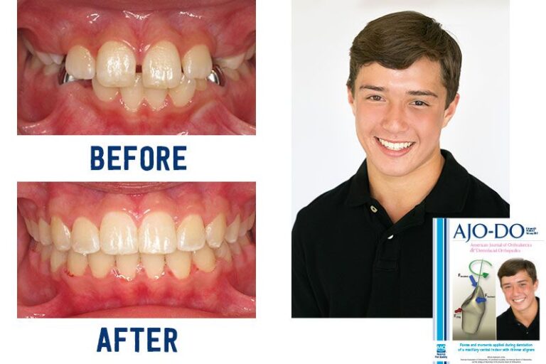 Before & Afters Ryan Cox Orthodontics Orthodontist Rome