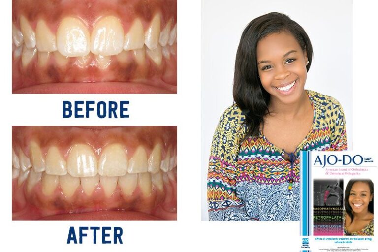 Before & Afters Ryan Cox Orthodontics Orthodontist Rome